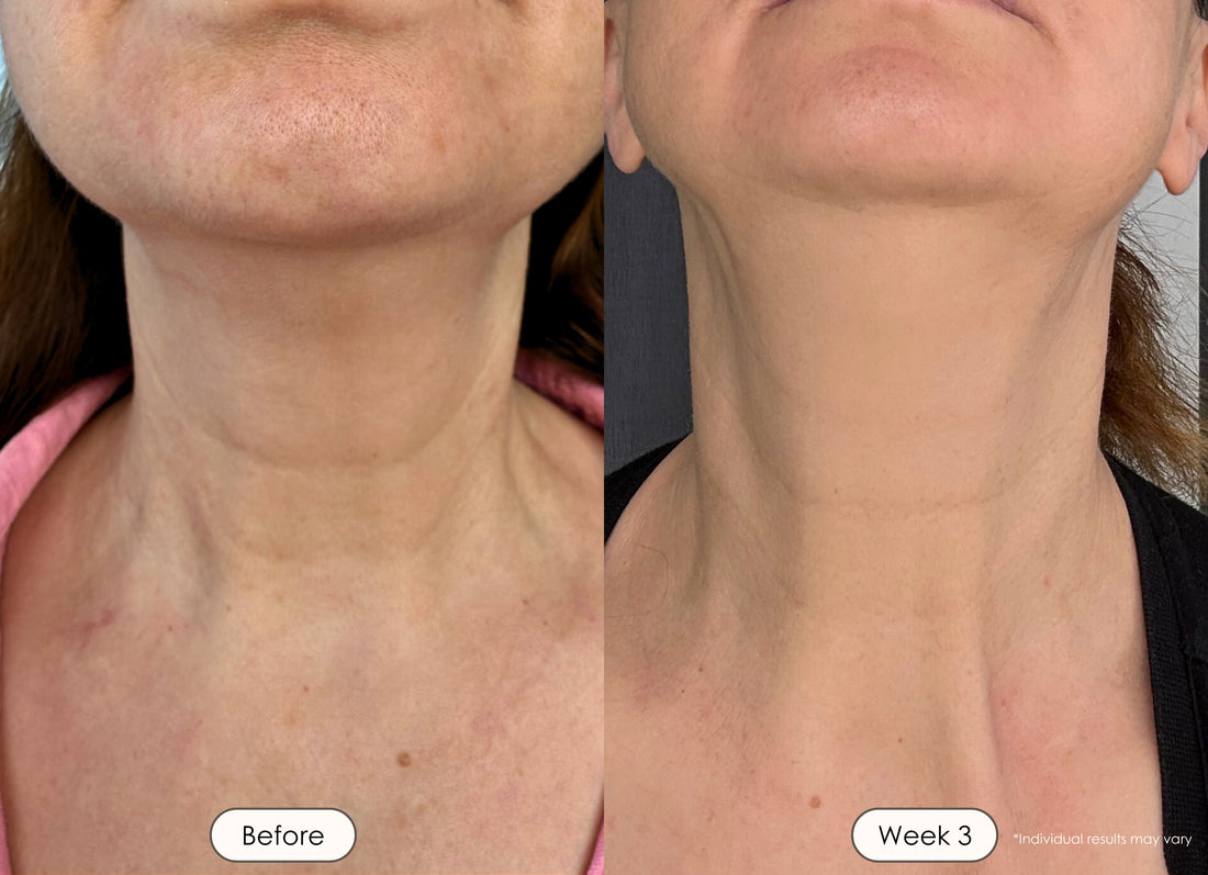 visible results after 3 weeks of using the LED light therapy neck and face mask